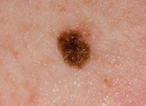 nevi e melanoma