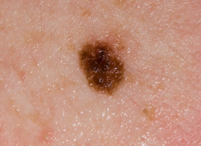 nevi e melanoma