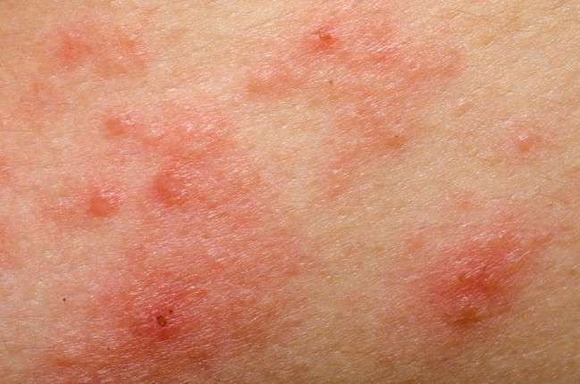 dermatite estiva