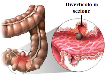 i diverticoli i diverticoli