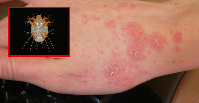 scabbia casi sospetti 222