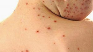 casi morbillo bergamasca