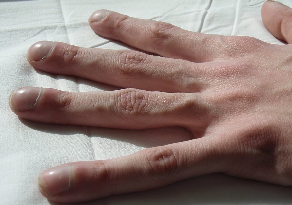 fibrosi cistica