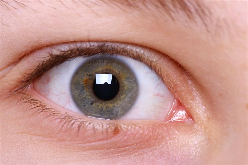 glaucoma