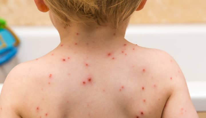 la varicella la varicella