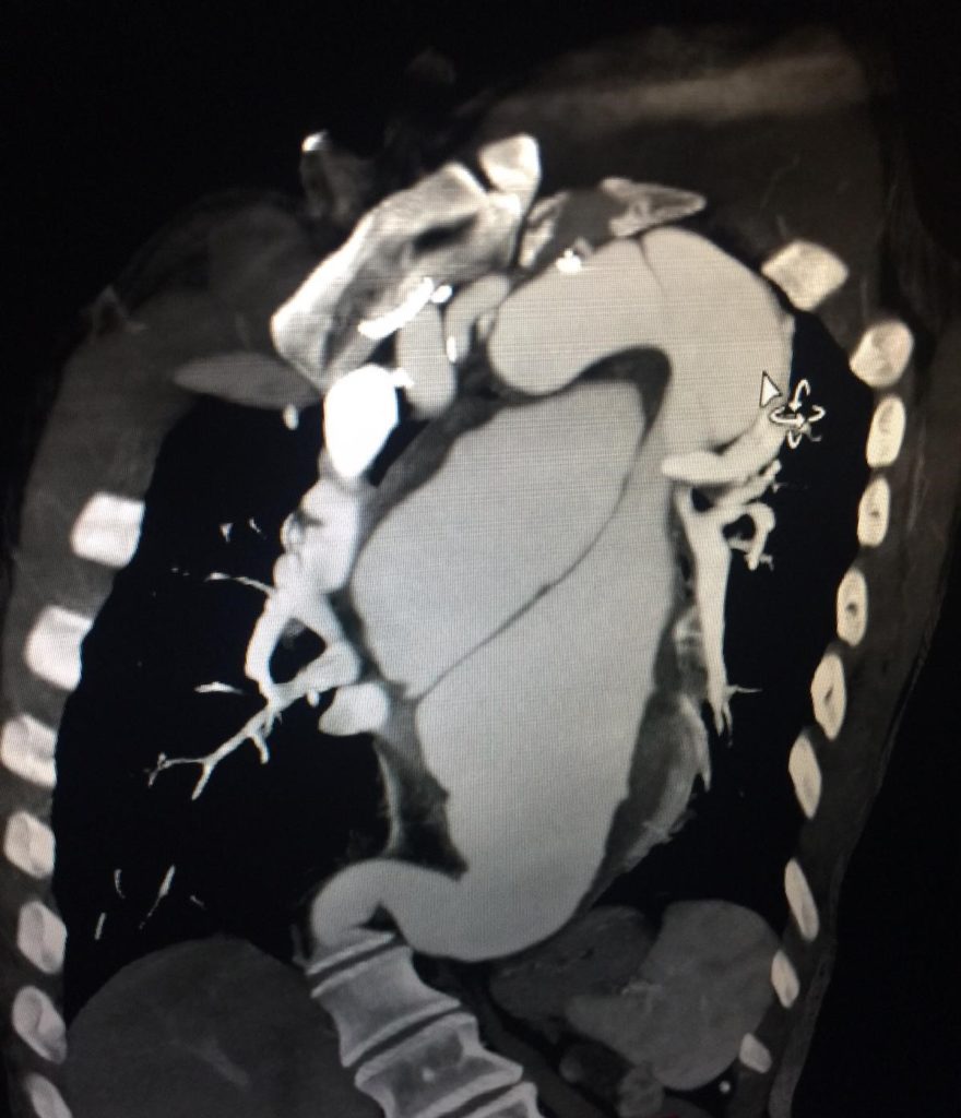 Aneurisma aorta Aneurisma aorta