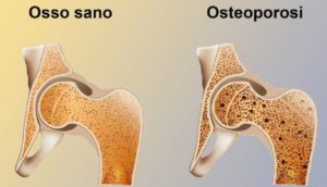 osteoporosi