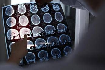 Rallentare lAlzheimer con il litio scoperta la scintilla che innesca la patologia