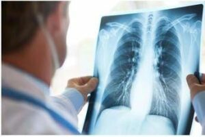 Tumore al polmone a piccole cellule in stadio esteso ok Aifa a primo anti Pd 1 in prima linea Tumore al polmone a piccole cellule in stadio esteso ok Aifa a primo anti Pd 1 in prima linea