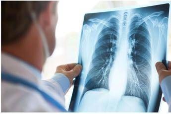 Tumore al polmone a piccole cellule in stadio esteso ok Aifa a primo anti Pd 1 in prima linea