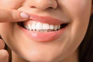 Denti a rischio tra i giovani Sidp Il 36 della Gen Z ha gengive che sanguinano