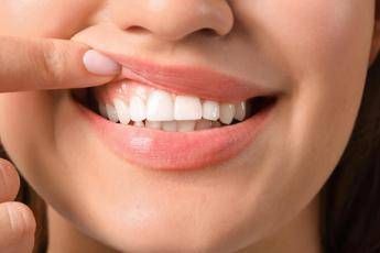 Denti a rischio tra i giovani Sidp Il 36 della Gen Z ha gengive che sanguinano