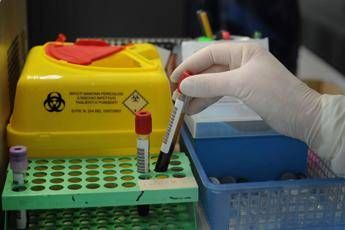 Alzheimer via libera a test del sangue per diagnosi cosa significa