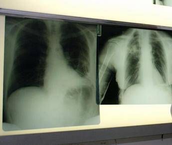 Cancro polmone a piccole cellule ok Ue a tislelizumab Cancro polmone a piccole cellule ok Ue a tislelizumab