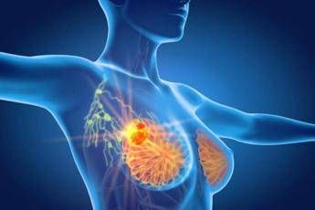 Tumore al seno triplo negativo speranze da anticorpo farmaco coniugato