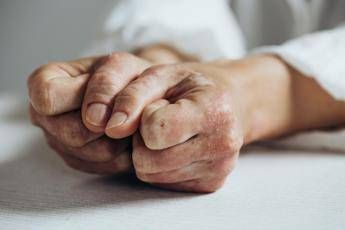 Lo studio inibitore Il 23 riduce segni e sintomi artrite psoriasica attiva