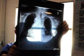 Tumori in carcinoma polmonare risultati positivi da combinazione in prima linea