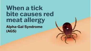Se una zecca rende allergici a carne e latticini cose la sindrome alfa gal