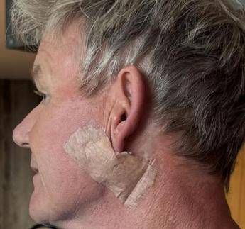 Gordon Ramsay Operato per tumore della pelle Gordon Ramsay Operato per tumore della pelle