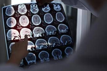 Nuove molecole e bersagli cosi si evolve la terapia contro lAlzheimer il punto