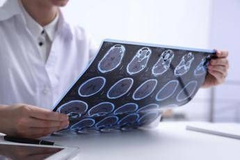 Sin Diagnosi piu rapide e farmaci innovativi cambiano decorso sclerosi multipla Sin Diagnosi piu rapide e farmaci innovativi cambiano decorso sclerosi multipla