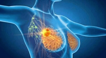 Cancro seno con profilazione molecolare e terapie target migliori prospettive di cura