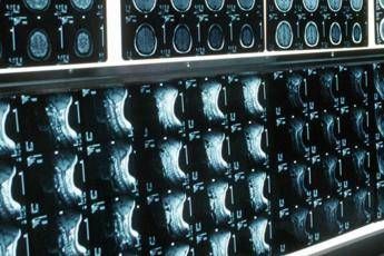 Ipofosfatemia legata allX primo bilancio e prospettive su linee guida