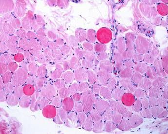 Malattie rare risultati positivi a 5 anni per vamorolone in distrofia Duchenne Malattie rare risultati positivi a 5 anni per vamorolone in distrofia Duchenne