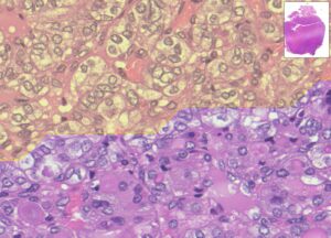 Immagini di campione analizzato con il sistema MiThyCA Immagini di campione analizzato con il sistema MiThyCA