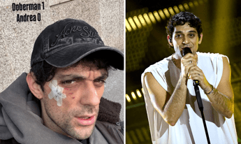 Bresh ferito al volto da un Dobermann come sta il cantante