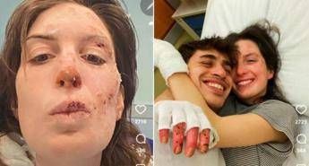Crans Montana oggi dimessi due ragazzi. Eleonora Palmieri mostra le ustioni sui social
