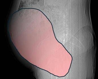 Intervento record al SantAnna di Torino rimosso tumore ovarico di 6 kg