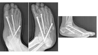 Piede di Charcot al Gemelli soluzioni avanzate per una complicanza rara del diabete Piede di Charcot al Gemelli soluzioni avanzate per una complicanza rara del diabete