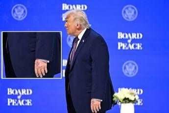 Trump nuovo grande livido sul dorso della mano sinistra il dettaglio non passa inosservato Trump nuovo grande livido sul dorso della mano sinistra il dettaglio non passa inosservato