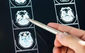 Ecco come il Long Covid cambia il cervello con meccanismi tipici dellAlzheimer