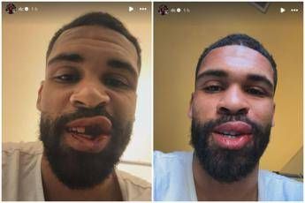 Loftus Cheek intervento riuscito alla mascella. E mostra foto dopo scontro in Milan Parma Loftus Cheek intervento riuscito alla mascella. E mostra foto dopo scontro in Milan Parma