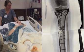 Milano Cortina Vonn mostra la gamba dopo le operazioni Dolore difficile da gestire Milano Cortina Vonn mostra la gamba dopo le operazioni Dolore difficile da gestire