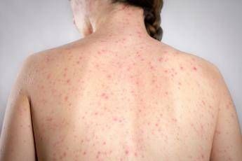 Morbillo dagli aeroporti Usa alle scuole di Londra dilagano gli alert Morbillo dagli aeroporti Usa alle scuole di Londra dilagano gli alert