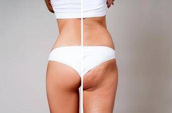 Gambe gonfie e cellulite per 8 donne su 10 la cura riparte dal sistema linfatico
