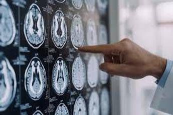 Stop tremori Parkinson senza bisturi 10 pazienti curati con ultrasuoni a Napoli Stop tremori Parkinson senza bisturi 10 pazienti curati con ultrasuoni a Napoli