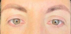Visione annebbiata o distorta spia di retinopatia. Ne soffre il 30 dei diabetici prevenzione larma piu efficace Visione annebbiata o distorta spia di retinopatia. Ne soffre il 30 dei diabetici prevenzione larma piu efficace